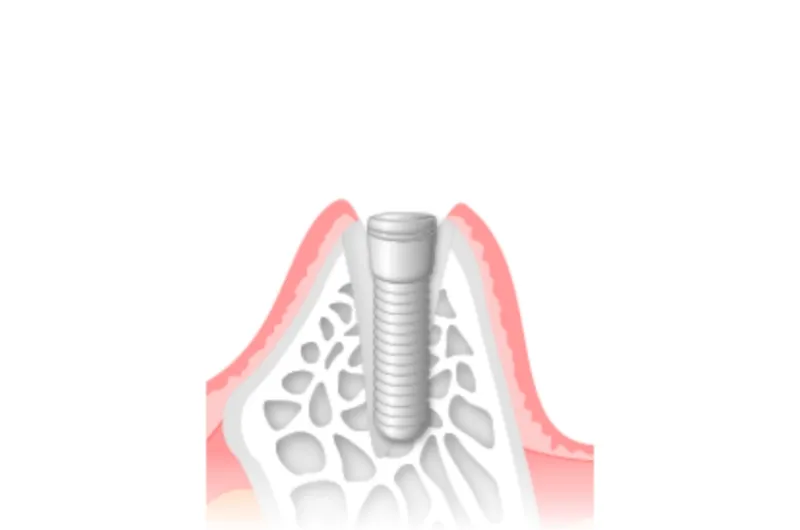 インプラント手術